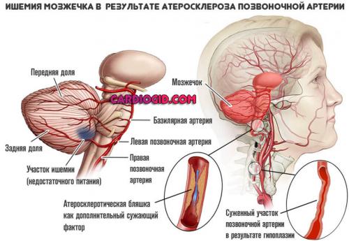 Может ли правильное питание и образ жизни помочь предотвратить сосудистые нарушения, вызывающие шум в ухе. Шум в голове и ушах: причины, как от него избавиться медикаментами, а когда нужна операция