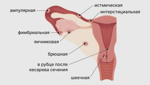 Почему болит живот у беременной в первом триместре: что делать и когда беспокоиться 03 Почему болит живот у беременной в первом триместре: что делать и когда беспокоиться 03