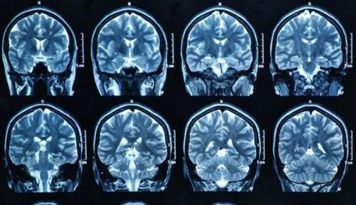 Какие результаты МРТ могут помочь врачу определить дальнейшее лечение при нарушениях мозгового кровообращения. Инсульт на МРТ головного мозга