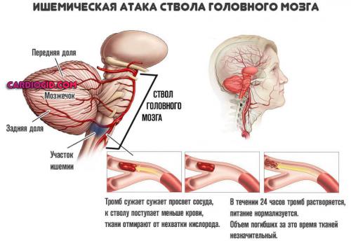 Какие стадии развития нарушений мозгового кровообращения выделяются. ОНМК (острое нарушение мозгового кровообращения): симптомы и причины, первая помощь, лечение и последствия