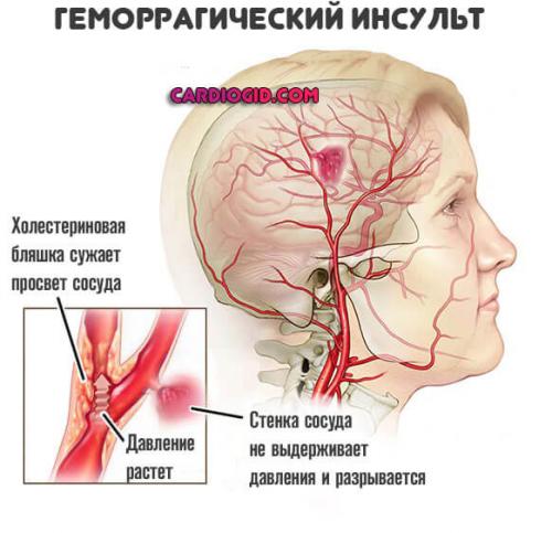 Какие стадии развития нарушений мозгового кровообращения выделяются. ОНМК (острое нарушение мозгового кровообращения): симптомы и причины, первая помощь, лечение и последствия