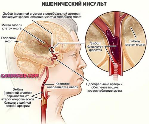 Какие стадии развития нарушений мозгового кровообращения выделяются. ОНМК (острое нарушение мозгового кровообращения): симптомы и причины, первая помощь, лечение и последствия