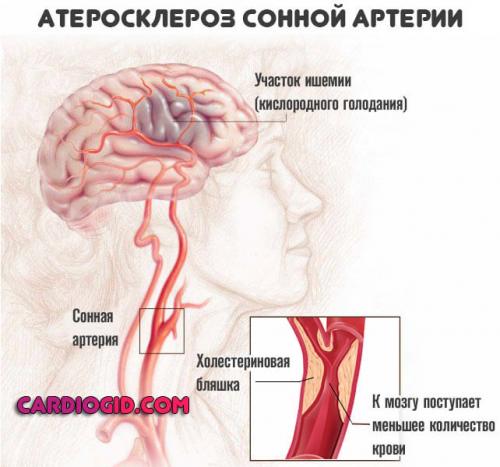 Какие стадии развития нарушений мозгового кровообращения выделяются. ОНМК (острое нарушение мозгового кровообращения): симптомы и причины, первая помощь, лечение и последствия