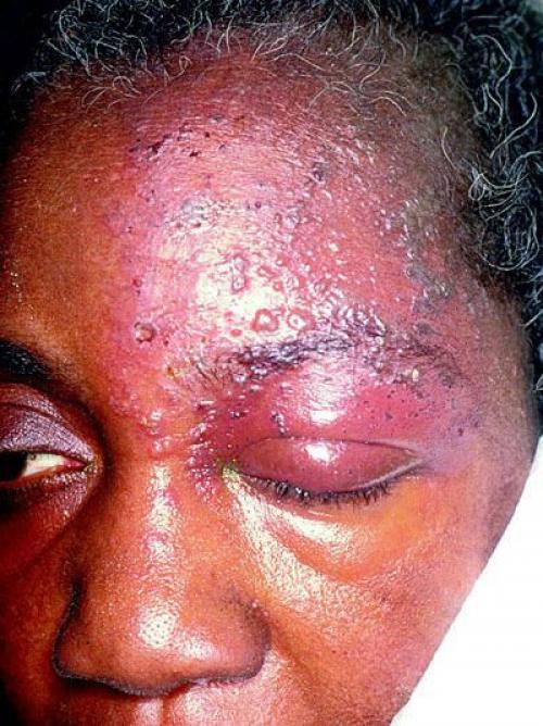 Воспаление тройничного лицевого нерва. Причины невралгии тройничного нерва 02 Воспаление тройничного лицевого нерва. Причины невралгии тройничного нерва 02