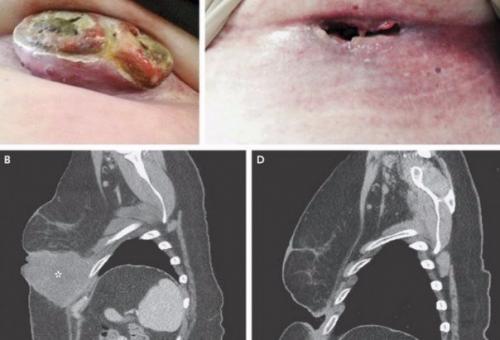 Противоопухолевая терапия подействовала так эффективно, что врачи испугались за здоровье вылеченной пациентки.

