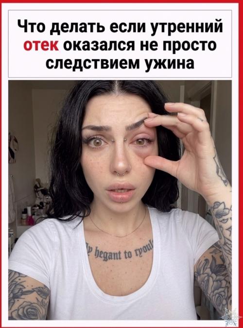 Почему после солёного отекают веки? 02