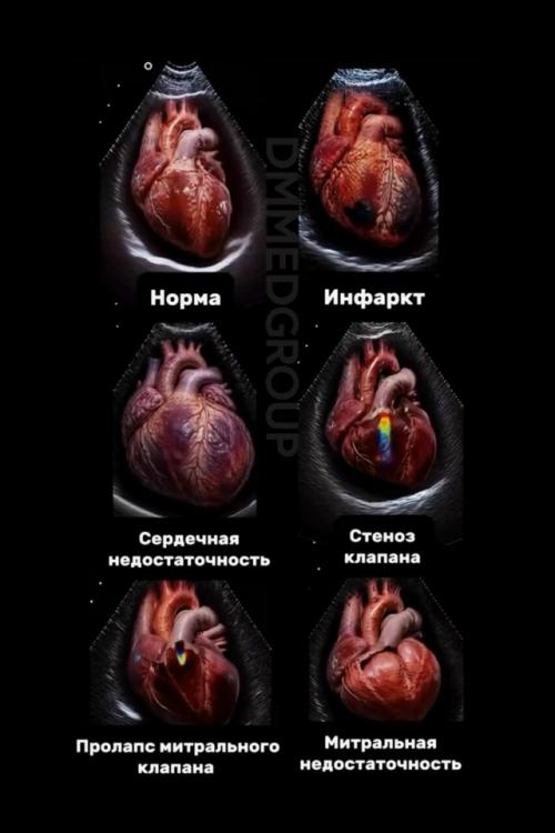 Эхокардиография (эхокг: что показывает узи сердца? 


