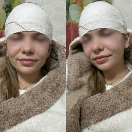 Россиянке разрезали лоб из-за выдавленного прыща.

