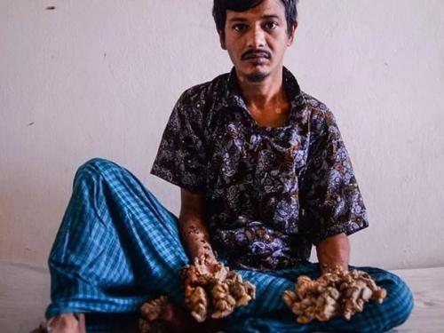 Человек - Дерево из Индии. 01