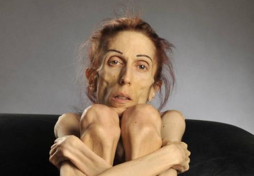 Аккуратнее с похудением! 01