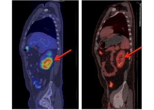 Американцы настоящего прорыва в лечении рака добились.  