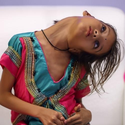 Маленькая Афшин из Пакистана в младенчестве получила тяжелую травму при падении, из-за чего её шея оказалась развернута почти на 90 градусов. 01