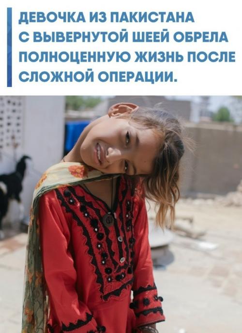 Маленькая Афшин из Пакистана в младенчестве получила тяжелую травму при падении, из-за чего её шея оказалась развернута почти на 90 градусов.  
