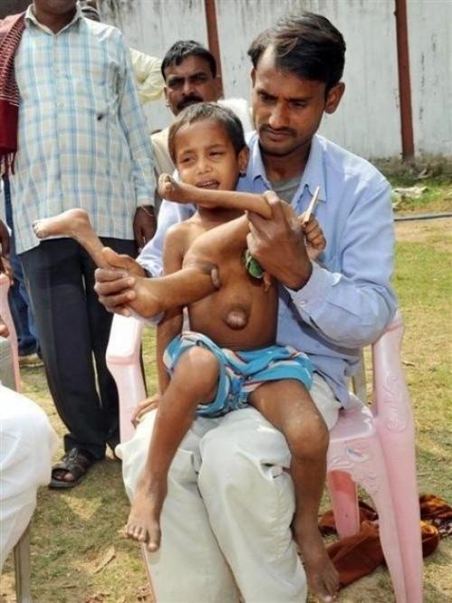 Мaльчик, родившийся с несколькими лишними конечностями. 03