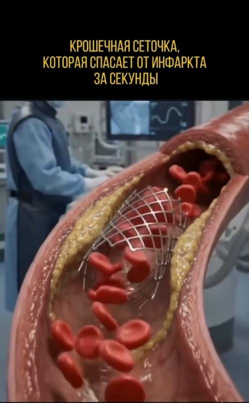 Перед вами стент - миниатюрная металлическая сетчатая трубка, работающая как Расширитель для артерий. 02