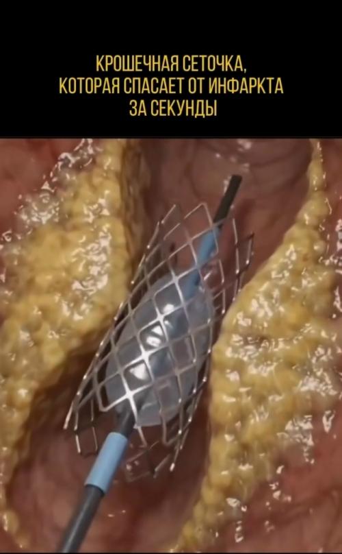 Перед вами стент - миниатюрная металлическая сетчатая трубка, работающая как Расширитель для артерий. 01