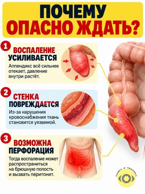 Аппендикс десятилетиями считали почти бесполезным Остатком Эволюции. 07 Аппендикс десятилетиями считали почти бесполезным Остатком Эволюции. 07