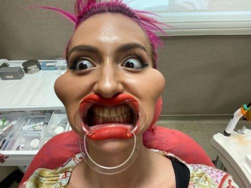 Украинка Анастасия покрищук _потратила целое состояние на новые скулы и стала звездой в Instagram. 01