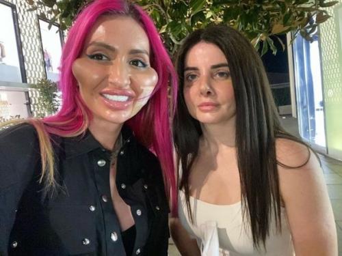 Украинка Анастасия покрищук _потратила целое состояние на новые скулы и стала звездой в Instagram. 06