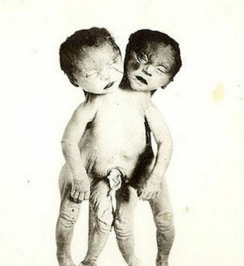 Один из загадочных феноменов при многоплодной беременности - исчезнувший близнец. 01