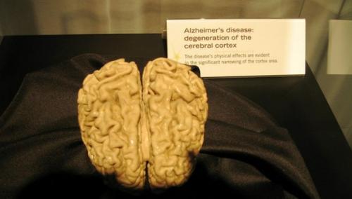 Ультразвук помог побороть потерю памяти при болезни альцгеймера. Ультразвук помог побороть потерю памяти при болезни альцгеймера.