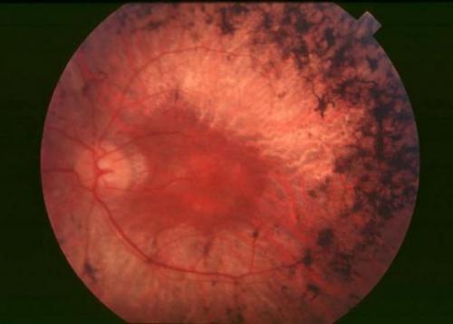 Редактирование генома применили для лечения слепоты. Редактирование генома применили для лечения слепоты.