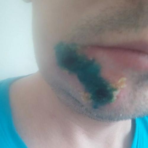 Первый подтвержденный случай оспы обезьян в Подмосковье нашли.

