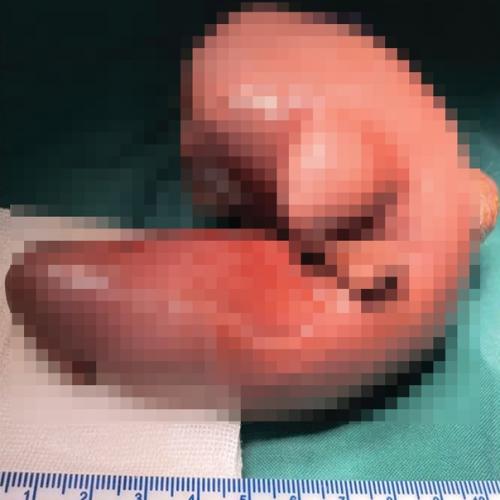 Врачи из Китая столкнулись с редчайшей аномалией: у одной годовалой девочки обнаружили близнеца в голове. 01