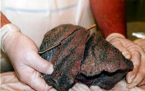 Легкие курильщика.  Не забывайте: курение приносит вред вашему здоровью! 01