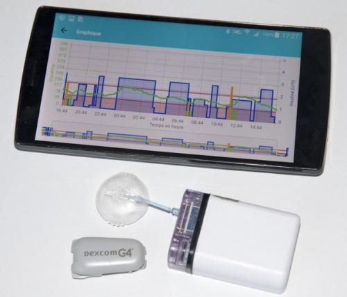 Во Франции создали аппарат искусственной поджелудочной железы.

