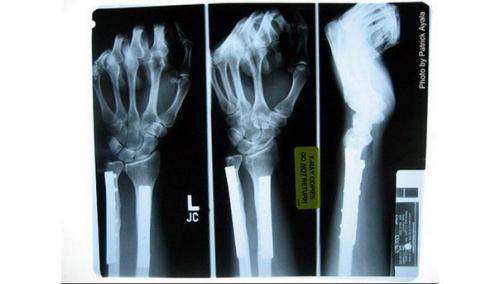 Возрастное разрушение костей удалось обратить одним уколом. Возрастное разрушение костей удалось обратить одним уколом.