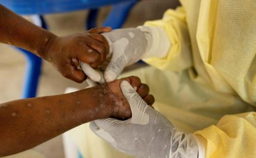 В Африке вспыхнула неизвестная болезнь с 14-процентной смертностью.

