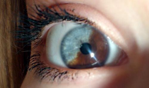 Частичная гетерохромия. ( Photo). 04