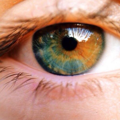 Частичная гетерохромия. ( Photo). 01