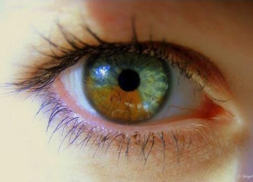 Частичная гетерохромия. ( Photo). 02