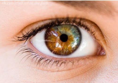 Частичная гетерохромия. ( Photo). 03