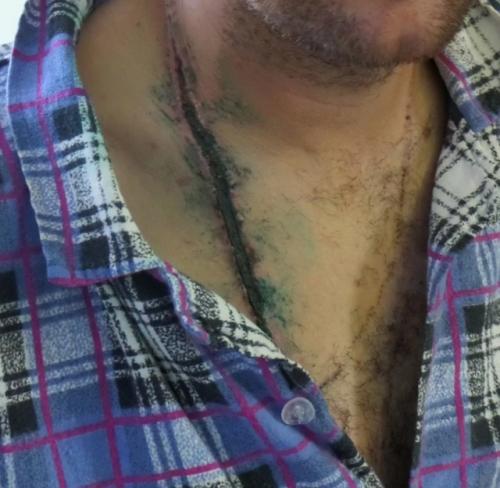 Невозможное возможно: россиянин получил удар током в 27 тысяч вольт и выжил. 01