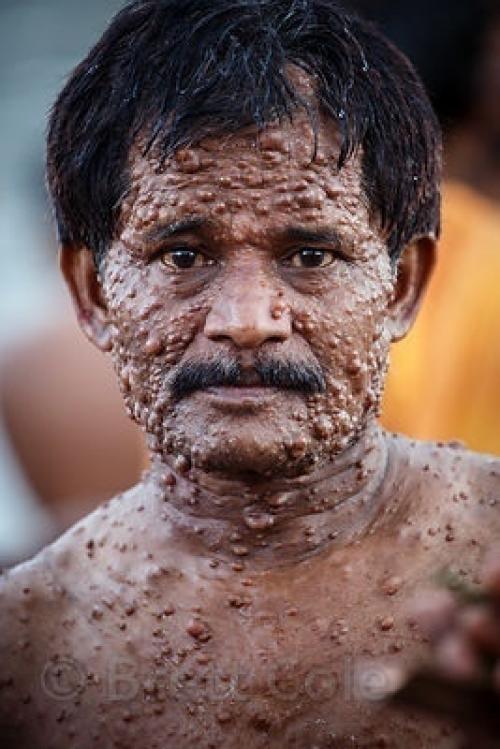 В современной медицине недуг именуют лепрой. 02
