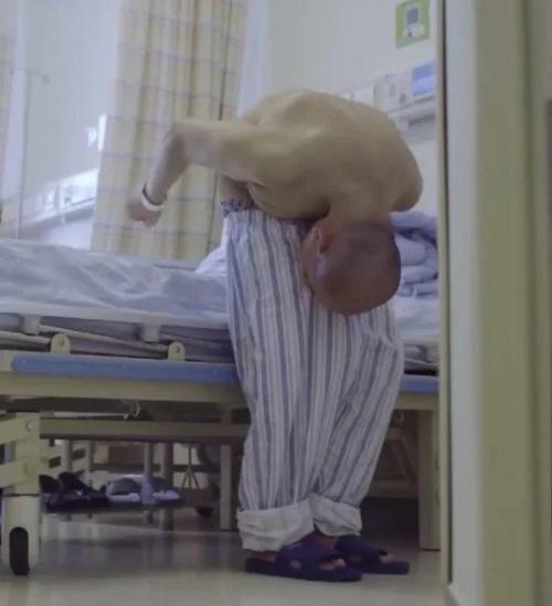 Был Согнут Пополам: в Китае мужчину вылечили от страшного заболевания. 02
