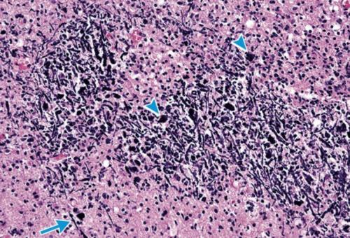 Получено первое ясное указание на связь вируса зика с микроцефалией.