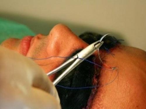 На днях лицо собаки было пересажено одному австралийскому художнику. 01