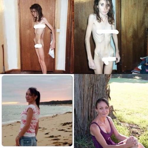 Девушки смогли победить анорексию. 04