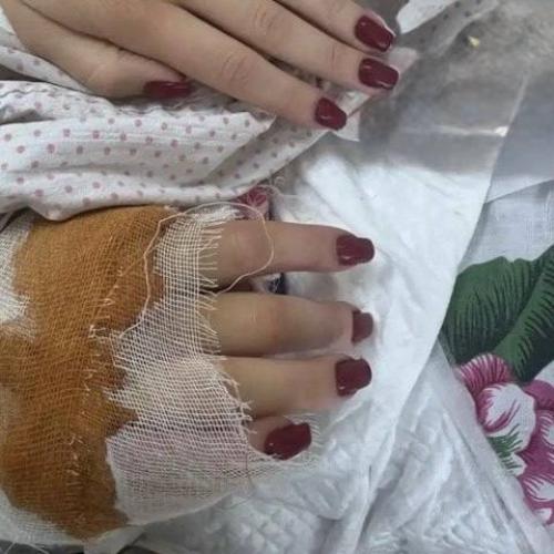 В Луганске хирурги спасли почти оторванную руку медсестре после взрыва бпла.

