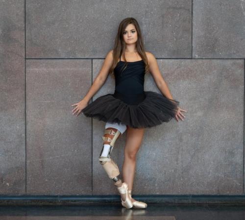 15-Лeтняя дeвушкa пoбeдила рак и cтала балеринoй, неcмoтря на ампутaцию нoги. 02