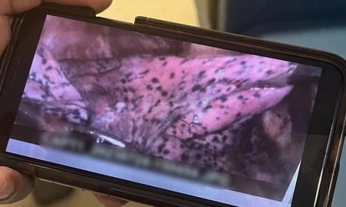 В США вейп  лёгкое 20-летнего парняСожрал. 02