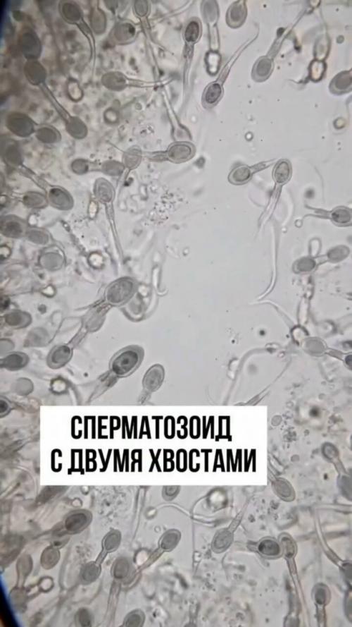 Что случится, если оплодотворение произойдёт сперматозоидом с двумя хвостиками? 

