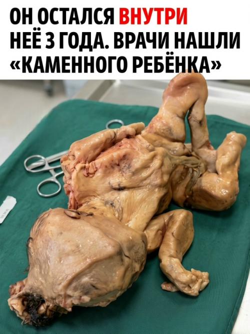 Три года назад её беременность прекратилась внезапно.  