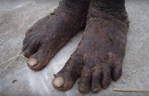 А парнишки редкий генетический недуг, его кожа выглядит как змеиная чешуя. 03