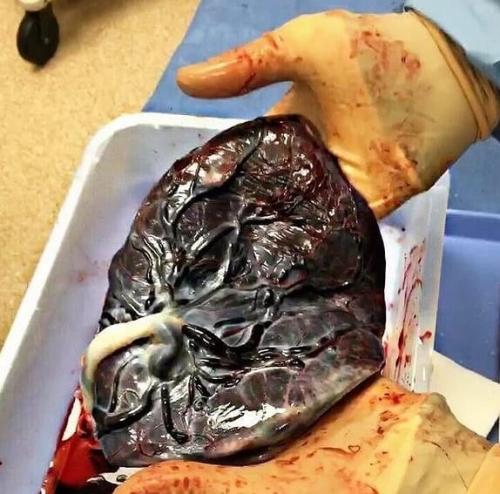 На фото плацента - важнейший и абсолютно уникальный орган, существующий только во время беременности. 02