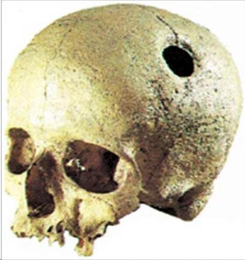 Инки - специалисты по трепанации черепа. 01